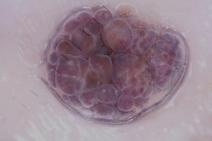 Nevus